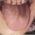 Lengua con saburra gris. Significado. MTC